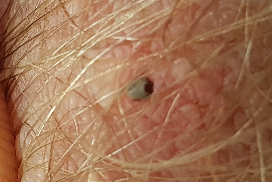 Bid / stik fra fl&aring;t p&aring; menneske