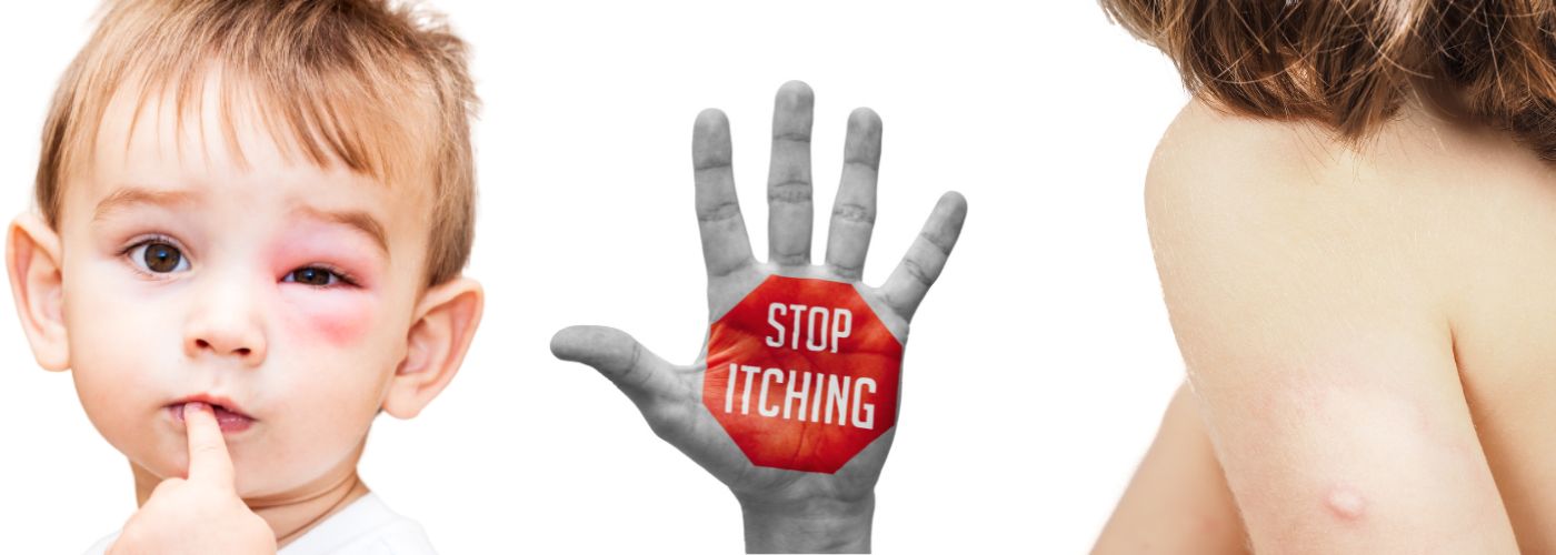 Getingstick under &ouml;gat p&aring; en pojke och getingstick p&aring; en kvinnas arm